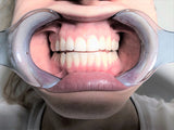 Photo Cheek Retractors - Long Handle(Kids), 992677 - numedical