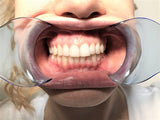 Photo Cheek Retractors - Double Ended, 992684 - numedical