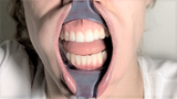 Photo Lip Retractors, 992685 - numedical