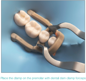 Distal-Extension Dental Dam Clamp, 2 types x 2pcs per pack, 998017 - numedical